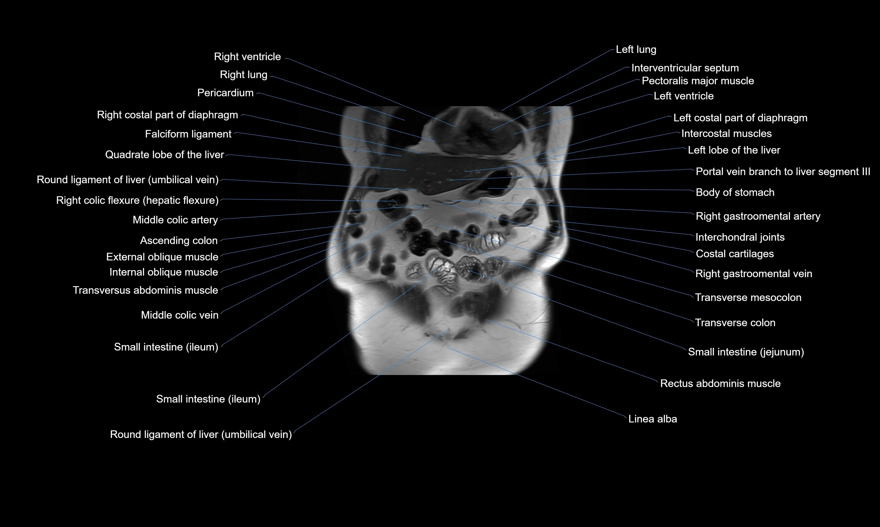 MRI Abdomen axial cross sectional anatomy radiology  image-img-00001-00013.webp